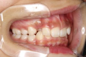 犬歯が口蓋側転位し、前歯のかみ合わせも深いです